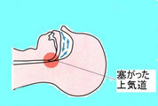 睡眠時無呼吸症候群