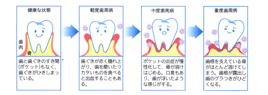 歯周病の分類 