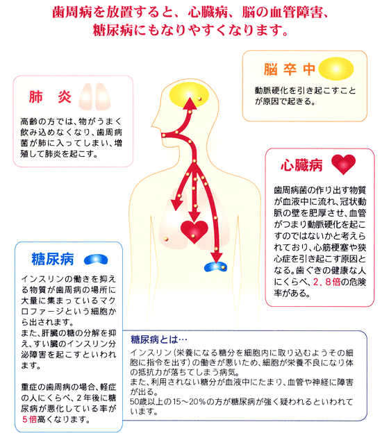 歯周病と全身疾患